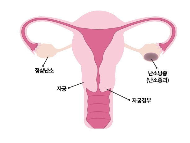 난소낭종이란?