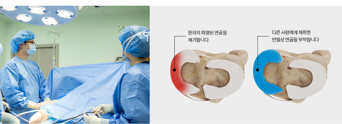 관절경하 연골판 이식술 사진