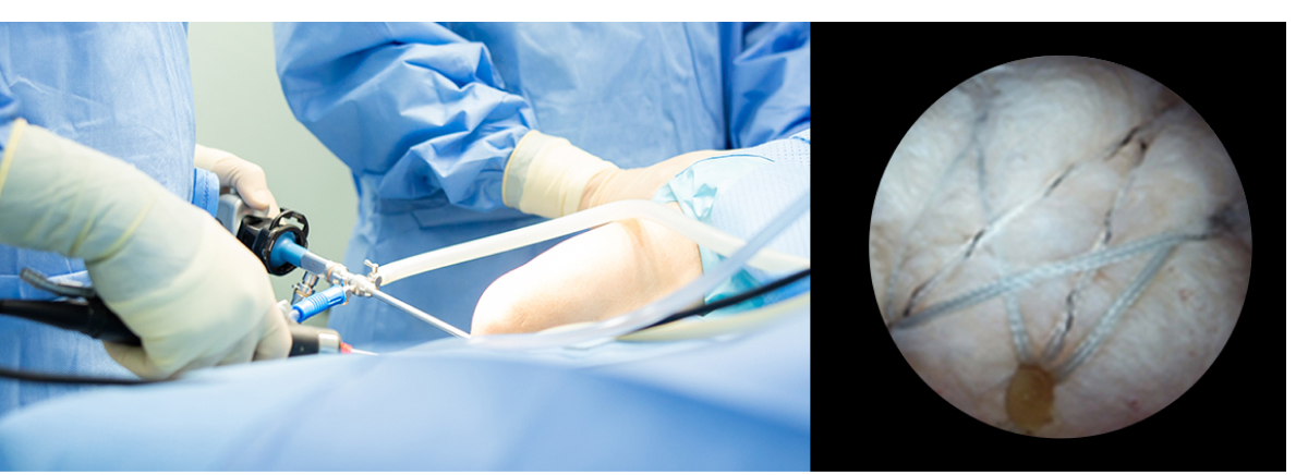 관절경하연골판봉합술 사진