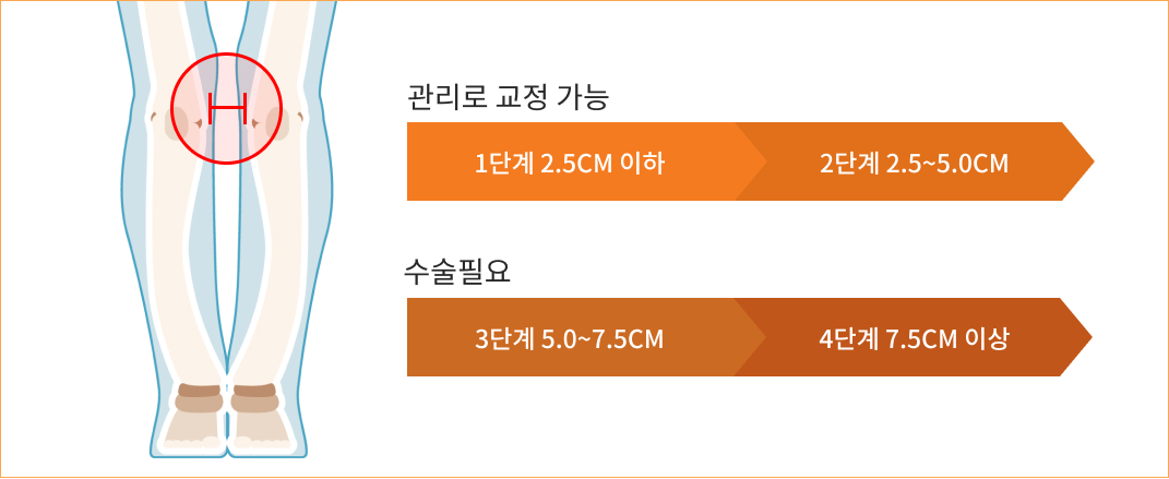 관리로 교정 가능 1단계 2.5cm 이하, 2단계 2.5~5.0cm, 수술필요 3단계 5.0~7.5cm, 4단계 7.5cm 이상