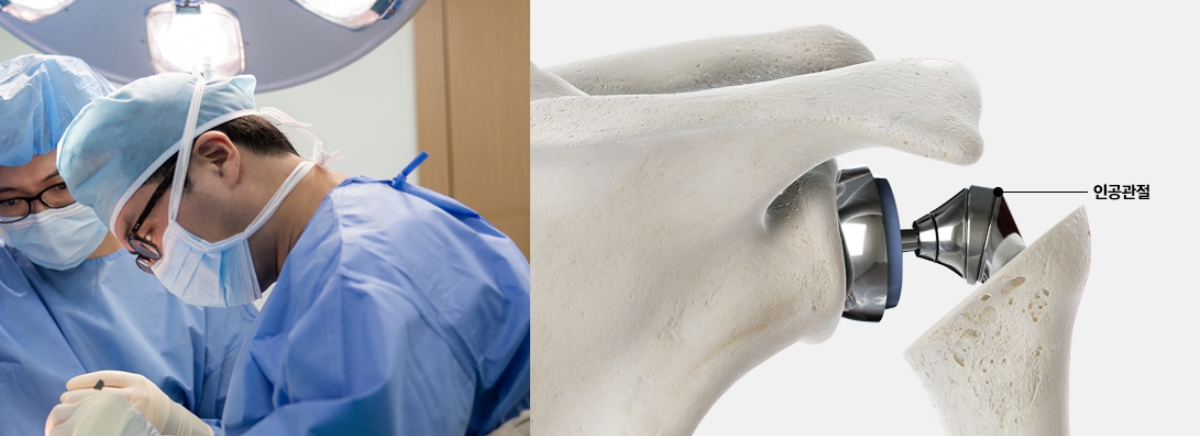 관절을 인공관절로 대체하는 예시 이미지와 수술 이미지