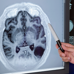 뇌 MRI