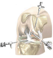 관절내시경 수술 장면