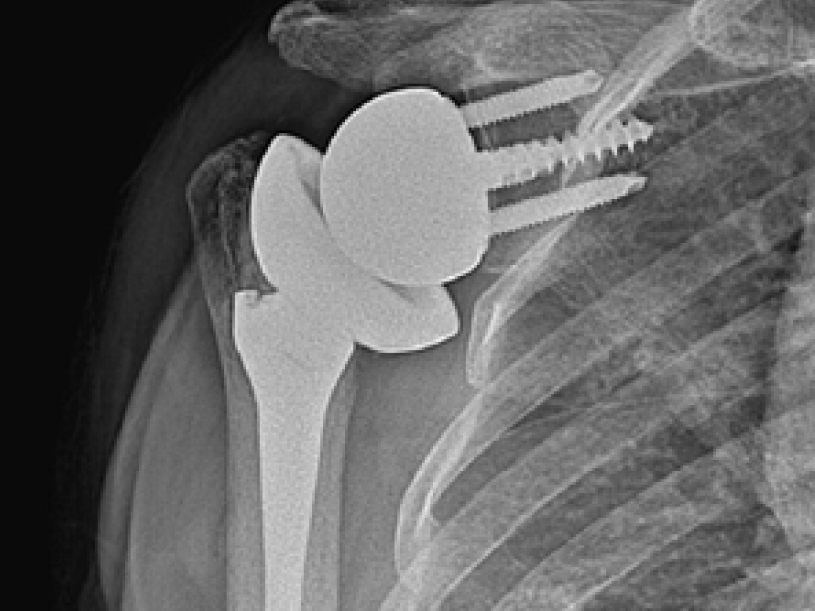 어깨 인공관절 수술 후 이미지