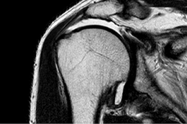 회전근개 파열 MRI