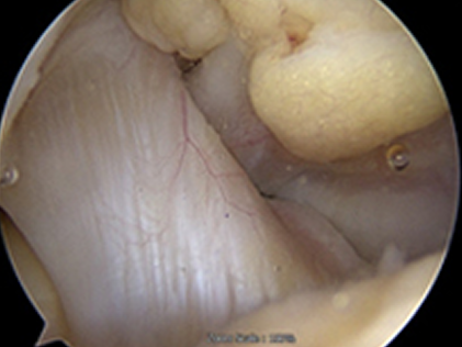 관절 내시경으로 본 정상 십자인대