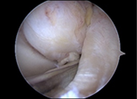 십자인대 재건술 과정 1
