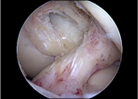 십자인대 재건술 과정 2
