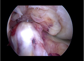 십자인대 재건술 과정 3