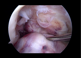 십자인대 재건술 과정 4