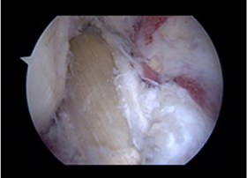 십자인대 재건술 과정 5