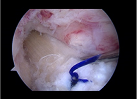 십자인대 재건술 과정 6