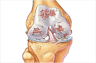 연골 결손 방치 후 퇴행성 가속화된 무릎