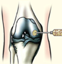 줄기세포 주사 이미지