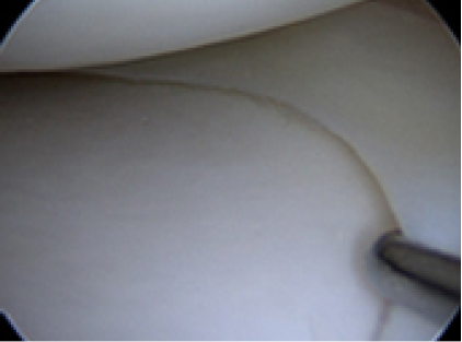 정상적인 반월상 연골판