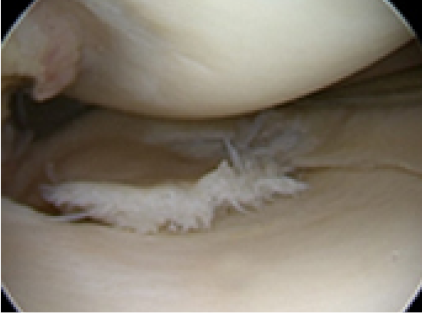 파열된 반월상 연골판