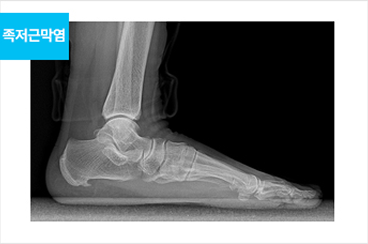 족저근막염 치료 후