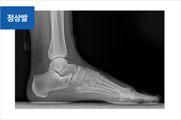 족저근막염 치료 전