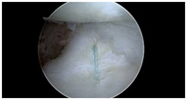 삼각섬유연골 복원