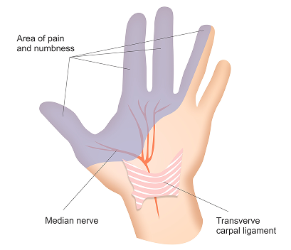 손목터널증후군