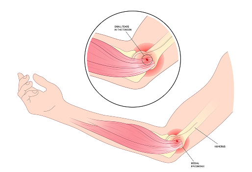 팔꿈치 인대파열