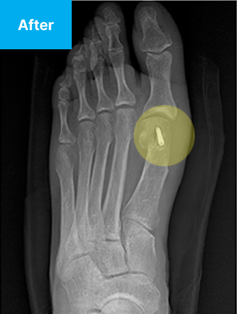 B-ita 바른마디병원 미타 최소침습 수술