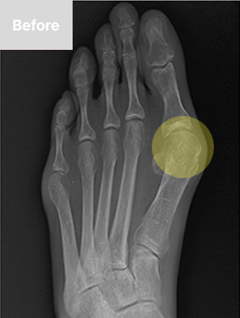 기존 절개교정수술