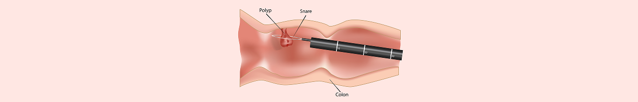 조직 검사 후 주의 사항