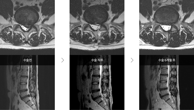 미세현미경수술 시술 사례