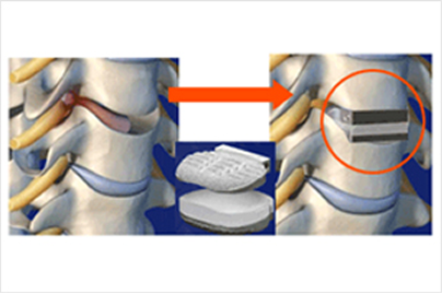 고령 및 심혈관계질환으로 전신마취와 수술 위험도가 높은 환자의 시술 사례