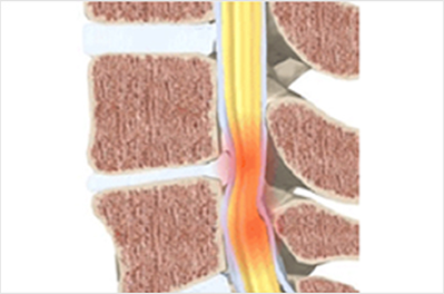 고령 및 심혈관계질환으로 전신마취와 수술 위험도가 높은 환자의 시술 사례