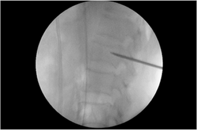 척추성형술 환자 시술 사례