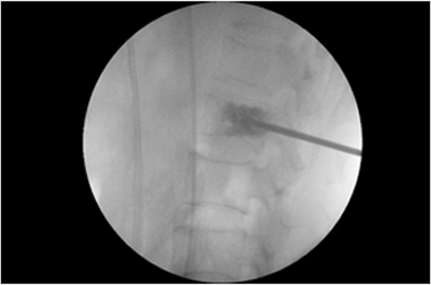 척추성형술 환자 시술 사례