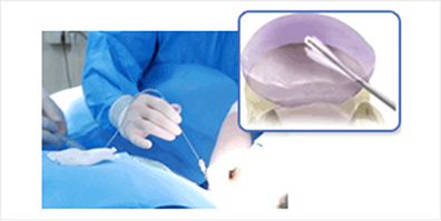 저온의 고수자를 이용하여 디스크에 따른 통증 해소