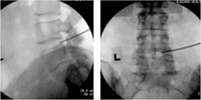 영상증폭장치를 통해 병변 부위를 보면서 치료 (허리디스크 적용)