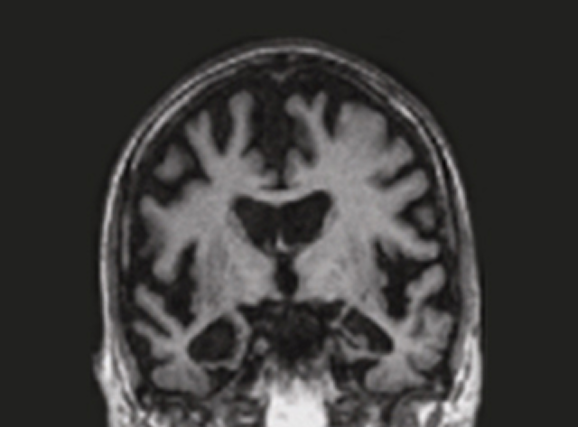치매 환자 뇌 영상