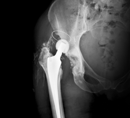 엉덩이마디 질환