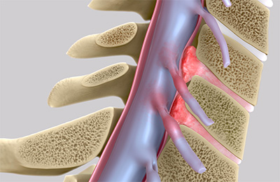 미세현미경수술 시술 사례