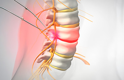 미세현미경수술 시술 사례