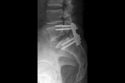 척추 디스크 나사 치료