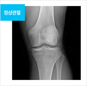 정상관절 img