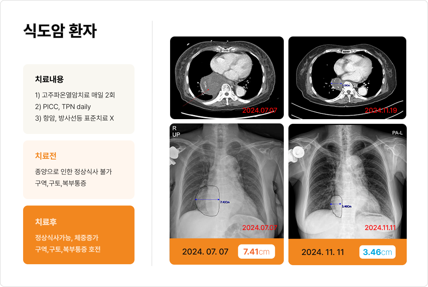 식도암 환자 치료 전후