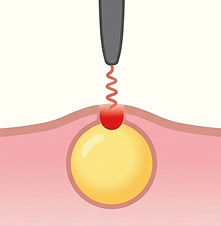 핀홀 제거술 1단계