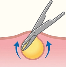 핀홀 제거술 2단계