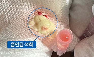 비수술적 압력해소