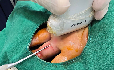 흉터 걱정 없는 미세 절개