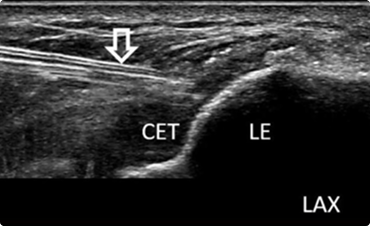 손상 조직 제거